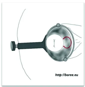 Figure 9 :  Examen gynécologique en DL – Visualisation du col utérin 
