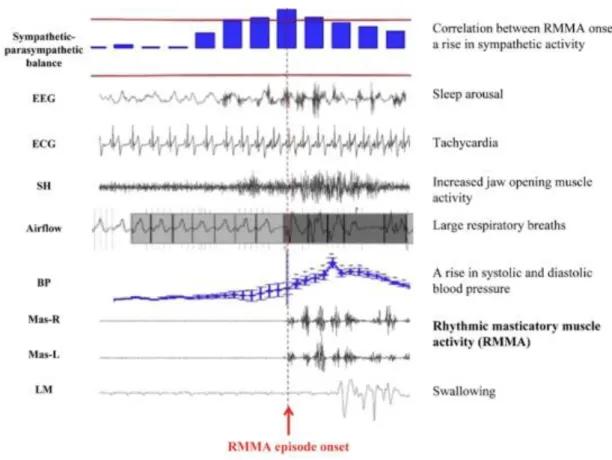 Figure 5 : Cascade d’évènements physiologiques précédant les épisodes d’ARMM  On note sur l’électromyographie des bouffées (burst) d’activation successives ; EEG :  électroencéphalogramme, ECG : électrocardiogramme, SH : électromyogramme du muscle supra  h