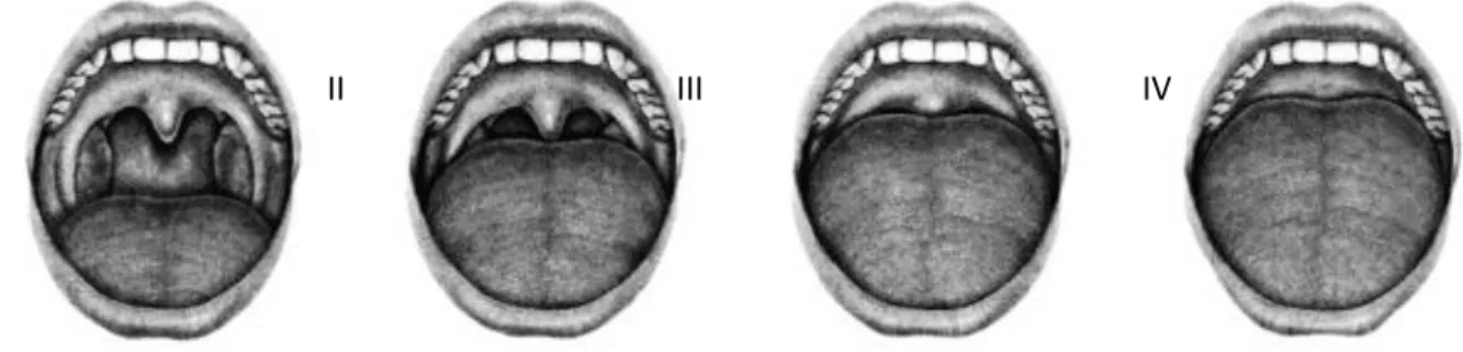 Figure 7 : Classification de Mallampati modifiée. Bouche grande ouverte et langue au repos  Classe I : les amygdales, les piliers et le palais mou sont clairement visibles