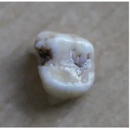 Figure 8 : Dent exclue de l’étude car lésion carieuse proximale ne permettant pas d’apprécier le  diamètre mésio-distal 