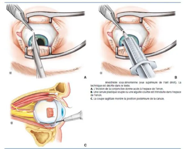 Figure 4 :  Anesthésie sous-ténonienne à l’aiguille mousse d’après J.-P Haberer, Anesthésie en  ophtalmologie EMC  21-780-A-10 