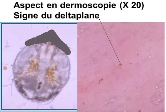Figure 4 : Aspect en dermoscopie (Source : HCSP) 