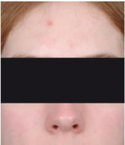 Figure 13 - Patiente atteinte d’une acné   de grade 2 selon l’échelle GEA (8) 