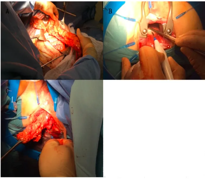 Figure A : Section colique et vérification du débord au de la symphyse pubienne  Figure B : Mucosectomie rectale après installation du Lone-star®  