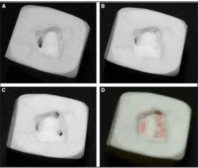 Fig. 18 : Traitement endodontique complexe d’un simulateur canalaire en céramique   (molaire mandibulaire)  