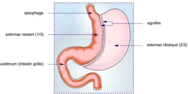 Figure 5. Schéma de la gastrectomie longitudinale (10)