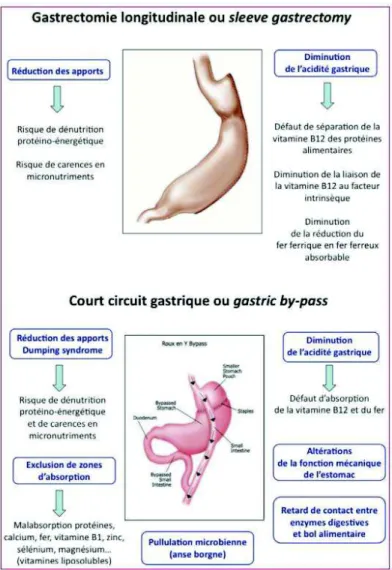 Figure 7. Conséquences de la chirurgie bariatrique sur la digestion et l’absorption selon le type de procédure  (19)