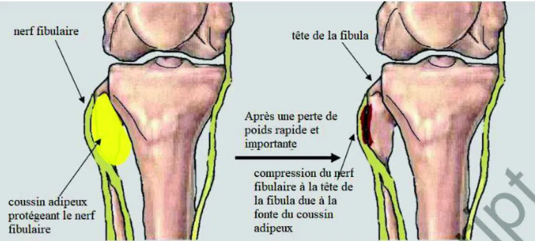 Figure 8. Mécanisme de la paralysie fibulaire après une chirurgie bariatrique (40) 