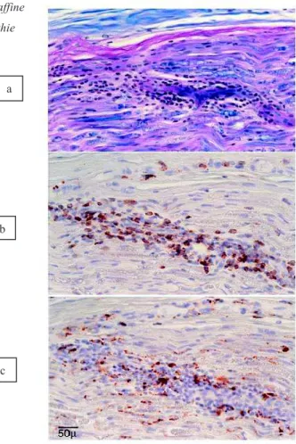 Figure 9. Coupe histologique après fixation et inclusion en paraffine  de biopsie nerveuse (nerf sural) dans un contexte de neuropathie 