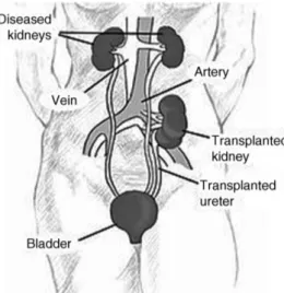 Figure 56.1 Kidney location after transplantation. Source: nih.gov.