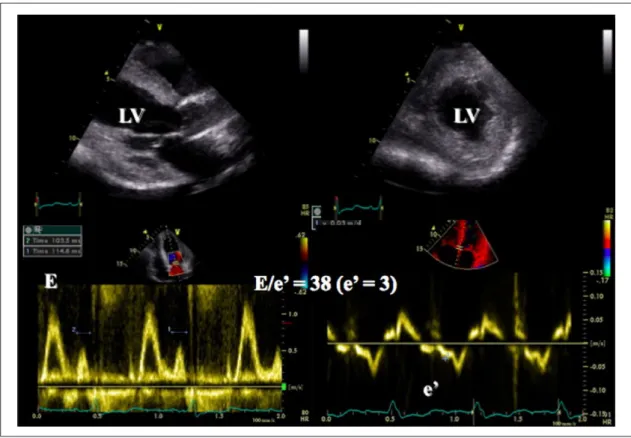 Figure 6.  Echocardiographic examination showing preserved left ventricular (LV) systolic function in a patient admitted for acute  dyspnoea