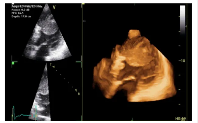 Figure 12.  3D transthoracic echocardiography showing a thrombus located in the left ventricular apex in a patient with recent ST  segment elevation myocardial infarction of the anterior wall