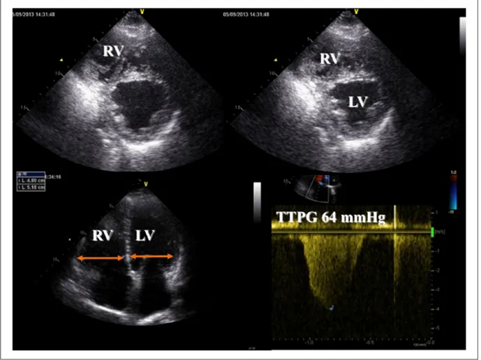 Figure 13.  Echocardiographic examination of a patient admitted for recurrent episodes of pulmonary embolism