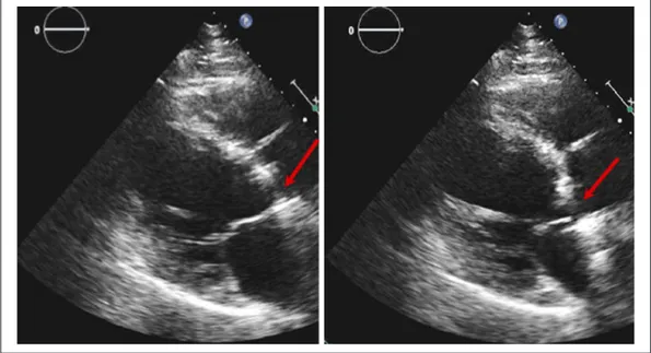Figure 16.  Same case as in Figure 15. The transoesophageal  short-axis view of the aortic prosthesis shows on colour  Doppler severe paraprosthetic regurgitation (approximately  from 7 to 1 o’clock and thus 50% of the circumference)
