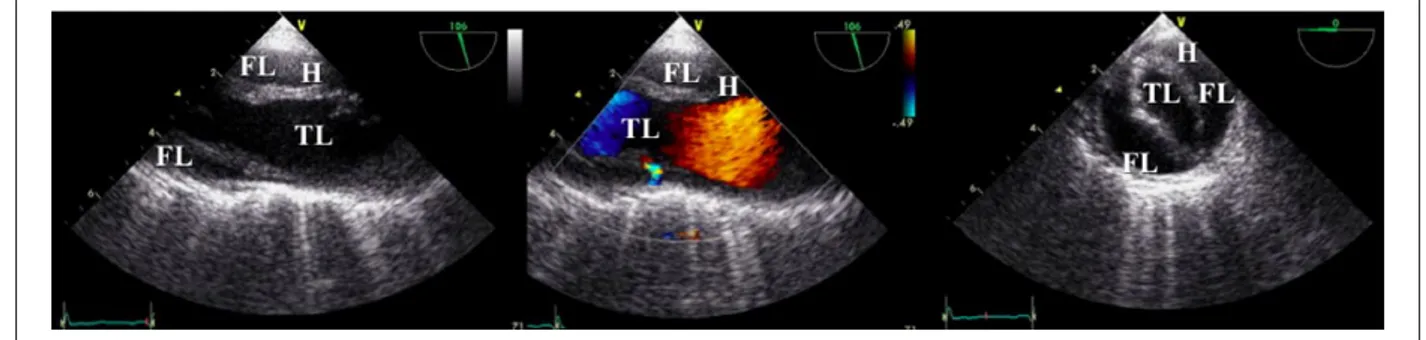 Figure 3.  Severe atherosclerotic disease of the descending thoracic aorta in an elderly patient