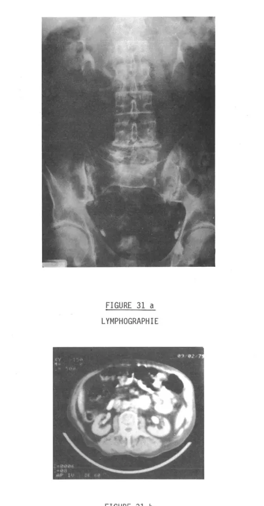 FIGURE  31  a  LYMPHOGRAPHIE 