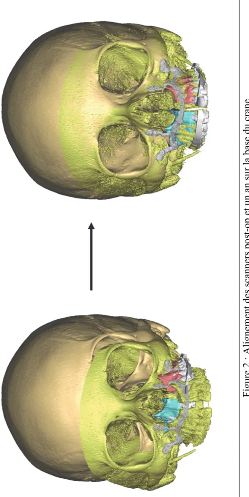Figure 2 : Alignement des scanners post-op et un an sur la base du crane 