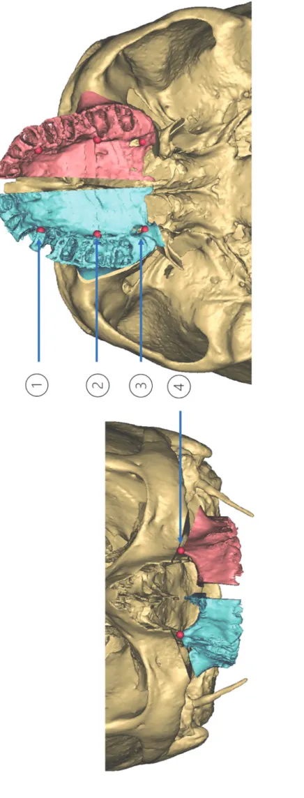 Figure 3 : Positionnement des points de repère osseux  1-au niveau canin de l’os palatin ; 2-au niveau molaire de l’os palatin ; 3-foramen grand palatin 4- orifice piriforme