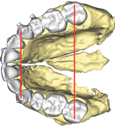 Figure 5 : Mesures manuelles des diamètres dentaires au niveau canin et 2eme molaire sur le scanner postopératoire (à gauche) et à un an (à droite)