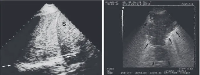 Figure 3 : Consolidation alvéolaire. A gauche : échogénicité tissulaire splénique (flèches  blanches) (S : Rate)