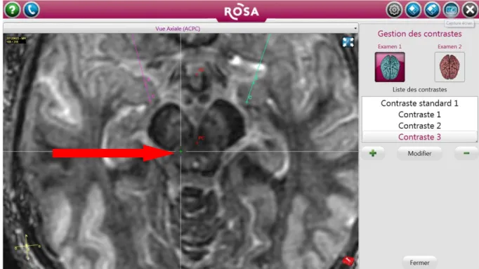 Figure 6 : séquence FGATIR modifiée d’une IRM cérébrale en coupe axiale, image issue du  logiciel  ROSANNA  visualisant  un  PPN  rostral  droit  de  taille  normale,  évaluation   semi-quantitative : 0 (absence d’atrophie), chez un patient du groupe contr