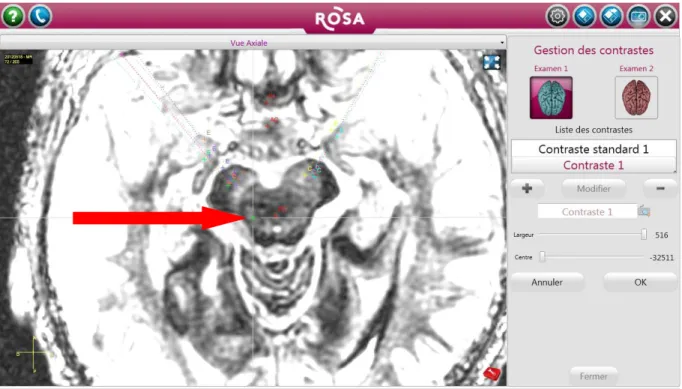 Figure 8 : séquence FGATIR modifiée d’une IRM cérébrale en coupe axiale, image issue du  logiciel  ROSANNA  visualisant  un  PPN  rostral  droit  de  taille  réduite,  évaluation   semi-quantitative : 2 (atrophie modérée), chez un patient du groupe FOG +