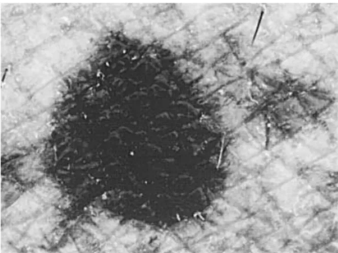 fig. 1 Appearance of actinic lentigo under ultraviolet light illumination