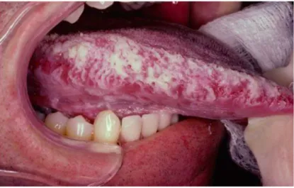 Figure 10 : Leucoplasie orale chevelue : 