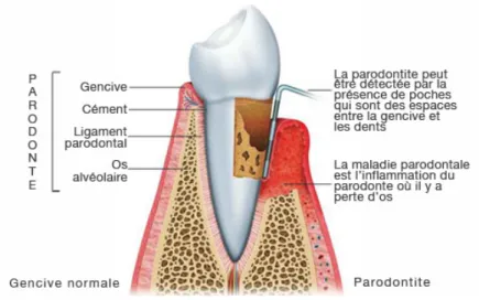 Figure 1 : La maladie parodontale 