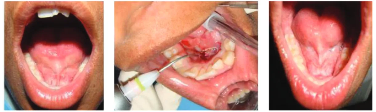 Figure 12 : Chirurgie d’un frein lingual au laser diode situations pré et per et post-opératoires [12]