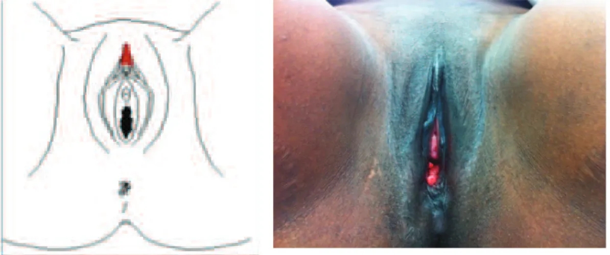 Figure 2 : MSF type IA ablation du capuchon clitoridien. 