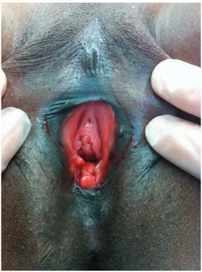 Figure 4 : MFS type IIb ablation totale du clitoris et de petites lèvres sans excision des grandes lèvres