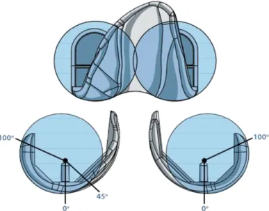 Figure 1 :  Rayons de courbure frontal et sagittal de  l’implant fémoral; d’après Micro Port Orthopedics