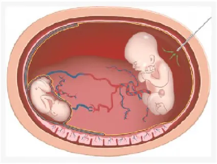 Figure 4 – Amniodrainage. D’après Hôpital Necker – Maladies rares 1