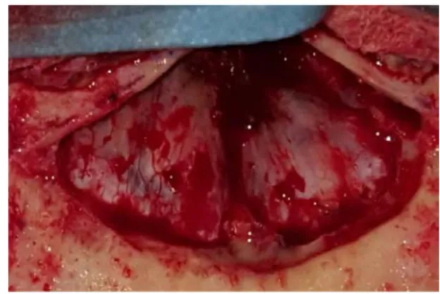 Figure 3B. Vue opératoire, après résection de la paroi postérieure du sinus frontal. Dure  mère frontale