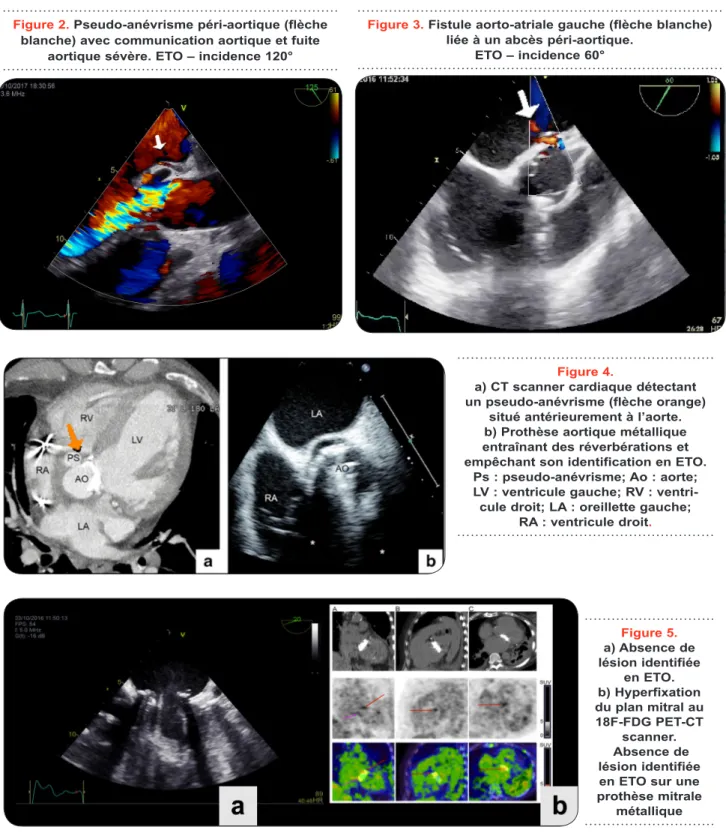 Figure 2. Pseudo-anévrisme péri-aortique (flèche  blanche) avec communication aortique et fuite 