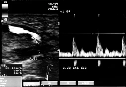 Figure  2  :  Echographie  avec  séquence  Doppler  :  anévrisme  partiellement  thrombosé  de  l’artère ulnaire