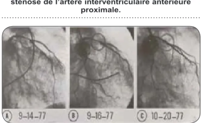 Figure 2. Première angioplastie coronaire per- per-cutanée réalisée le 14 septembre 1977 sur une  sténose de l’artère interventriculaire antérieure 