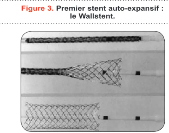 Figure 3. Premier stent auto-expansif :   le Wallstent.
