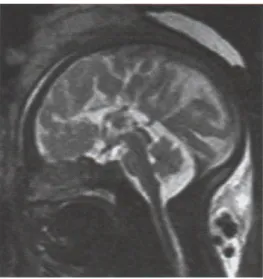 Figure 4 : IRM cérébrale à 34 sa, on note l’absence de corps calleux [6] 