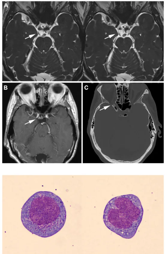 Fig. 2 Two of the myeloid blasts identified in the CSF
