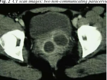 Fig. 2  CT scan images: two non-communicating paracervical abscesses 