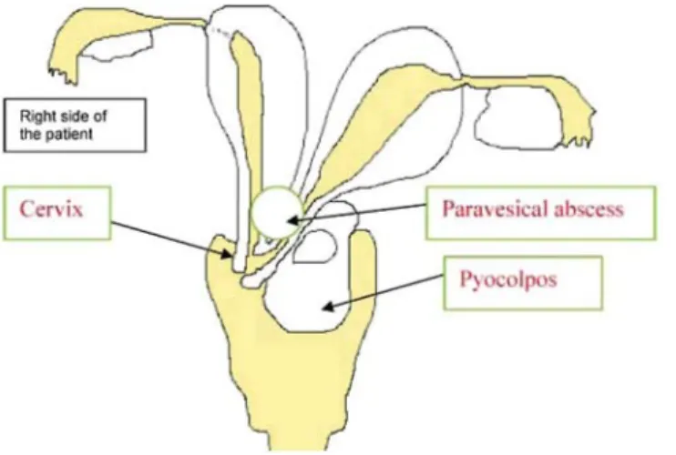 Fig. 4 Overall schematic representation: cervix deviated to the right fornix; left pyocolpos and paravesical  abscess 