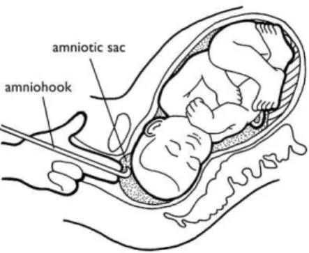 Figure 4 – Technique de réalisation d’une amniotomie   7.  Indications 