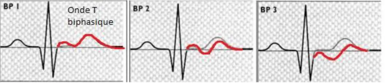 Figure 1: Anomalie de l’onde T biphasique en rouge 