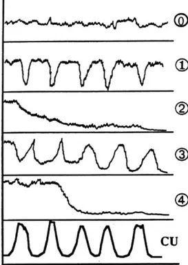 Fig n° 11 .Les différents tracés cardiotocographiques d’expulsion [36] 