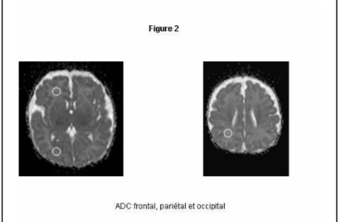 Figure 3a Figure 3b BIP cérébral Figure 3c Mesure de la corne  frontale si dilatée  (supérieure à 5 mm) Figure 4a et b Maturation à terme