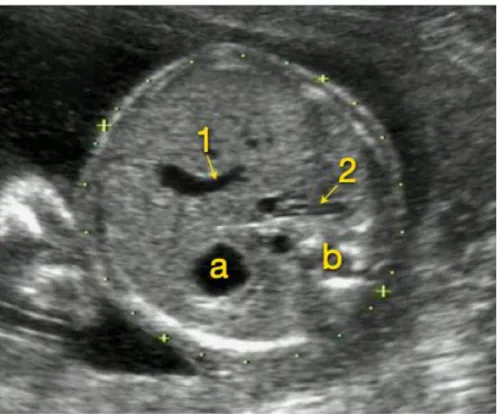 Figure 5 : Mesure du PA 