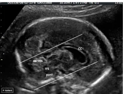 Figure 11 : Mesure du corps calleux  