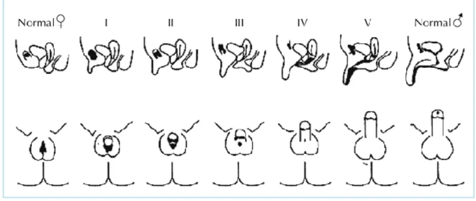 Figure 2 Classification de Prader.